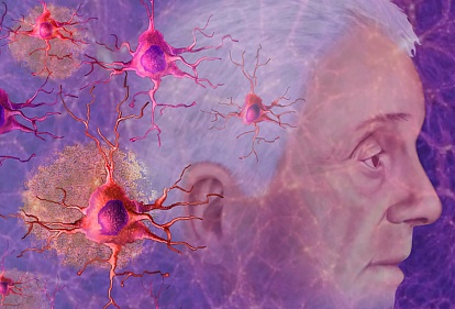 Nature Medicine: установлены случаи заражения болезнью Альцгеймера